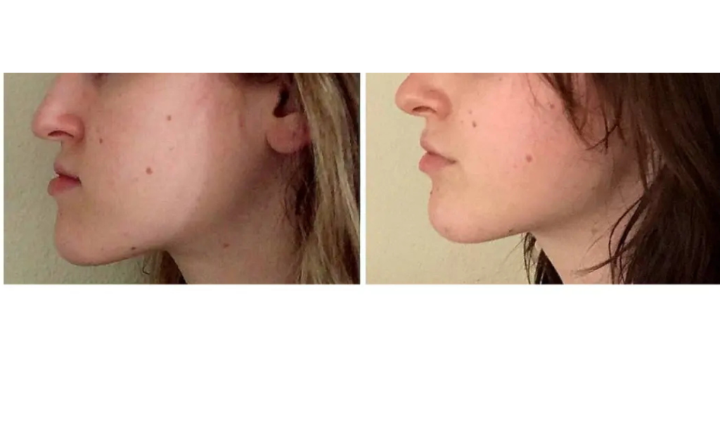 تجربتي مع عملية جراحة الفكين your paragraph text (100)