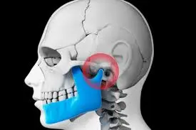 علاج التهاب مفصل الفك الصدغي