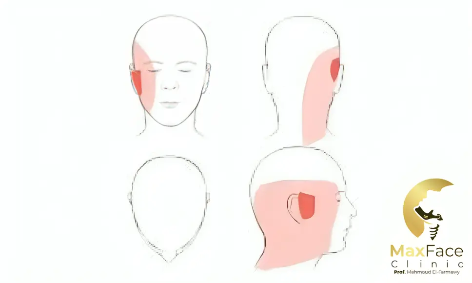 علاج انزلاق غضروف مفصل الفك علاج انزلاق غضروف مفصل الفك