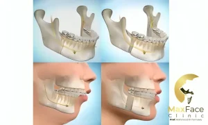 الفرق بين تقويم الأسنان وجراحة الفكين: كيف تختار العلاج المناسب لحالتك؟ الفرق بين تقويم الأسنان وجراحة الفكين