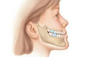 بروز الفك السفلي: الأسباب والأعراض وطرق العلاج بدون جراحة أو بالتقويم والجراحة بروز الفك السفلي عند الاطقال