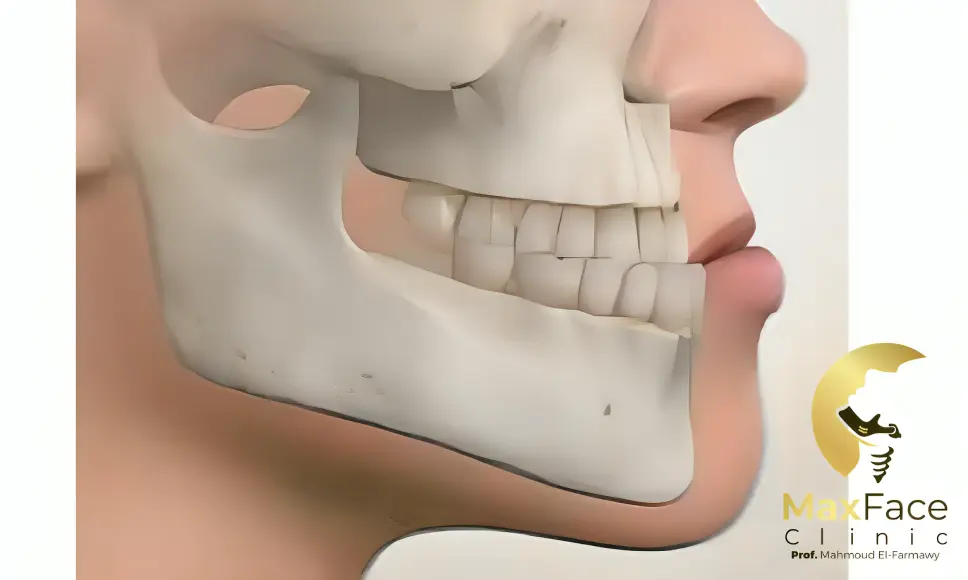 بروز الفك السفلي: الأسباب والأعراض وطرق العلاج بدون جراحة أو بالتقويم والجراحة بروز الفك السفلي وطرق علاجة