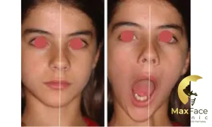 علاج انحراف الفك: متى يكفي التقويم ومتى تحتاج جراحة؟ (دليل شامل) علاج انحراف الفك