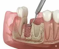 أسباب زراعة عظم الفك و من هم المرشحين و أنواع زراعة عظم الفك أسباب زراعة عظم الفك 2