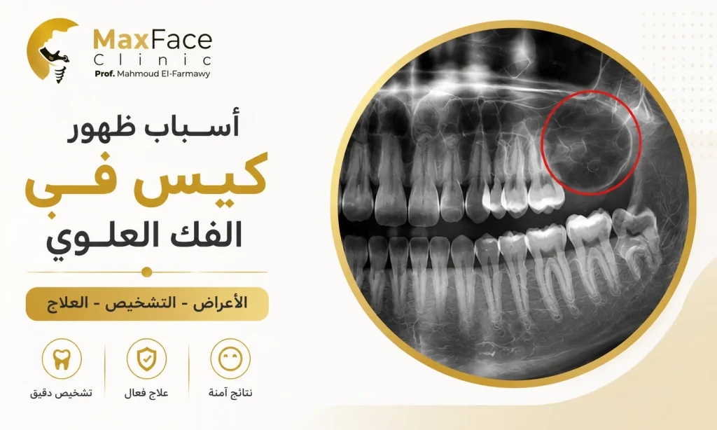 أسباب ظهور كيس في الفك العلوي | الأعراض وطرق العلاج وموعد الجراحة أسباب ظهور كيس في الفك العلوي