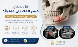 هل يحتاج كسر الفك إلى عملية؟ ومتى يكون التدخل الجراحي ضروريًا؟ هل يحتاج كسر الفك إلى عملية