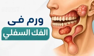 ورم في الفك السفلي : الأسباب والأعراض وطرق التشخيص والعلاج ورم في الفك السفلي