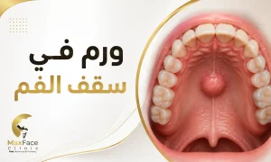 ورم في سقف الفم : الأسباب والأعراض وطرق العلاج ورم في سقف الفم