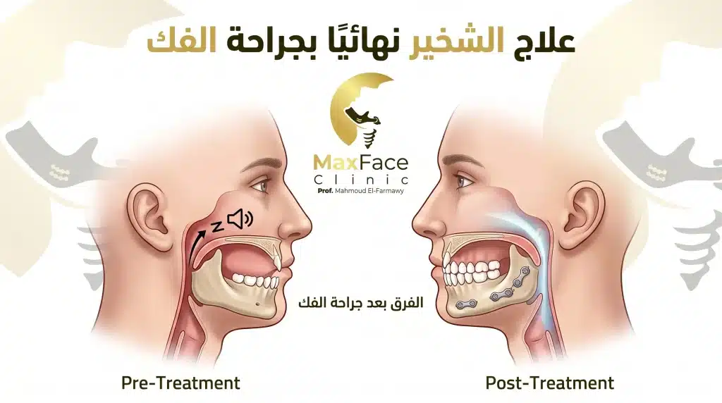 علاج الشخير نهائيًا بجراحة الفك: هل هي الحل الأمثل لك؟ علاج الشخير نهائيًا بجراحة الفك