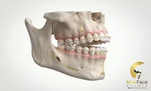 علاج العضة المفتوحة