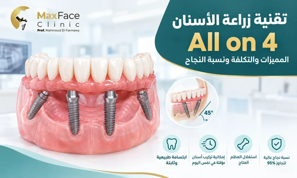 تقنية زراعة الأسنان all on 4