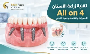 تقنية زراعة الأسنان all on 4