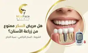 زراعة الأسنان لمرضى السكر