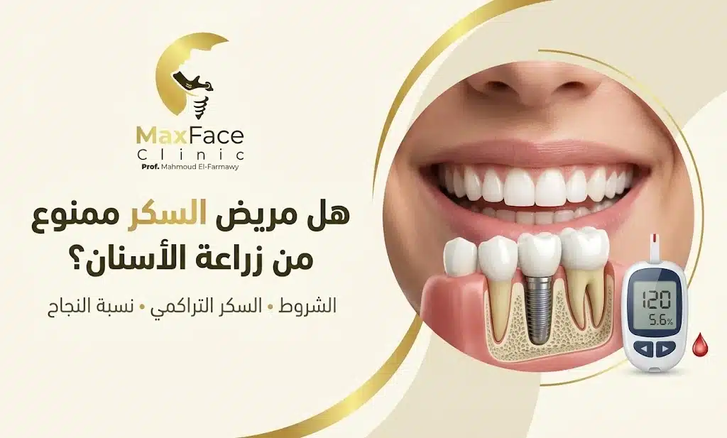 زراعة الأسنان لمرضى السكر